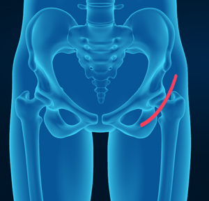 Direct Anterior Hip Replacement