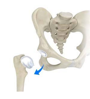 Outpatient Anterior Approach Hip Replacement