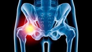 Complex Hip Replacement