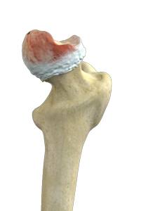 Osteoarthritis of the Hip