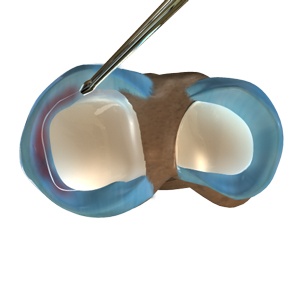Partial Arthroscopic Meniscectomy