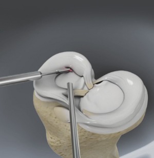 Partial Meniscectomy