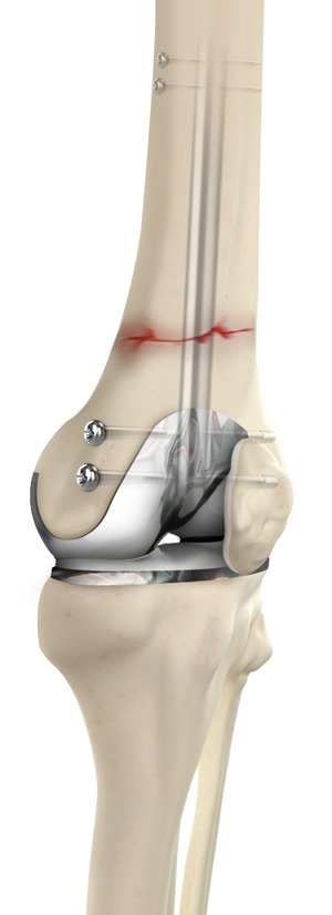 Periprosthetic Fracture Care