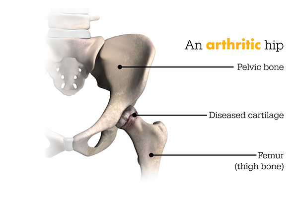 Arthritic Hip