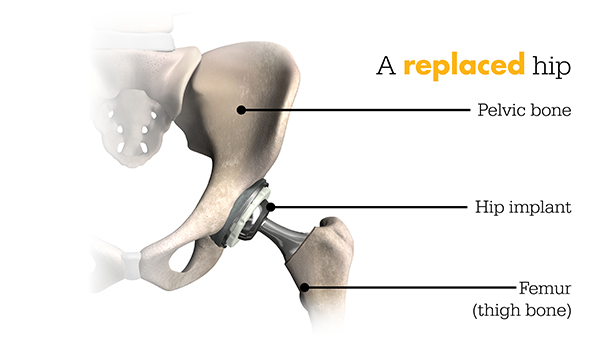 Replaced Hip