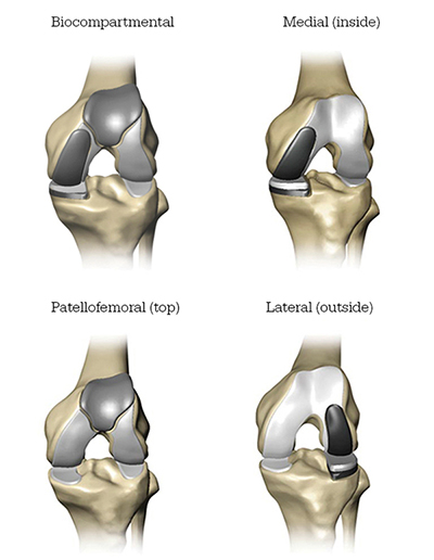 Mako Robotic-Arm Assisted Partial Knee replacement