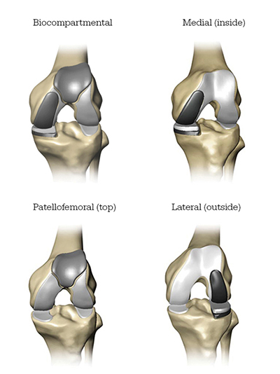 Mako Robotic-Arm Assisted partial knee replacement